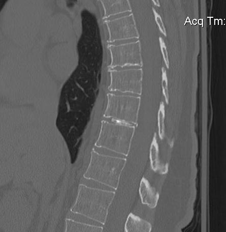 Thoracic Disc Calcified CT 1